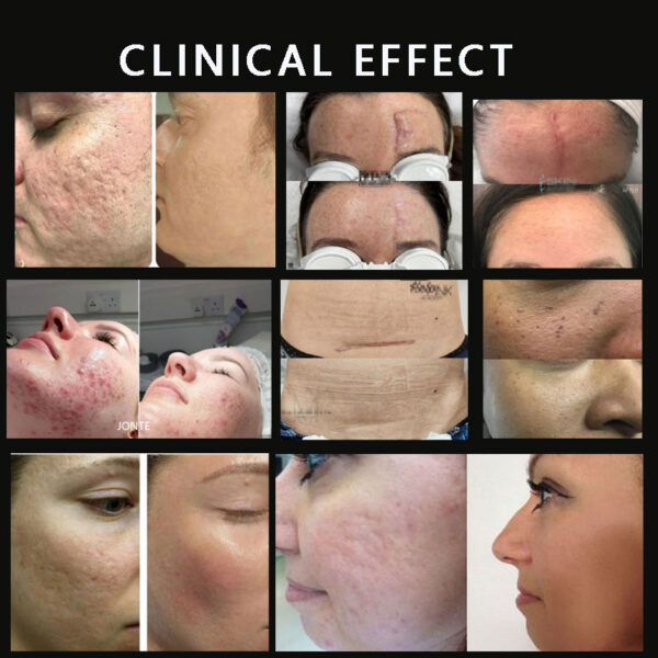 产品图6 CO2 Fractional Laser Machine: The Gold Standard for Professional Skin Resurfacing